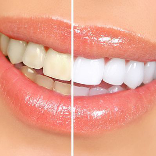 Sabbybeauty: Teeth Whitening Service